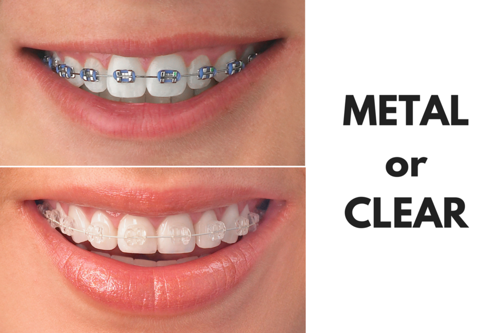 Metal & Ceramic Braces